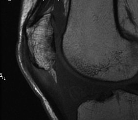 Patella Tendonitis Calcification MRI